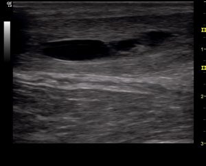 L/S Ultrasound 1st visit